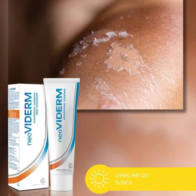 Opekline od sunca - što ako ih unatoč SPF-u zadobijete?